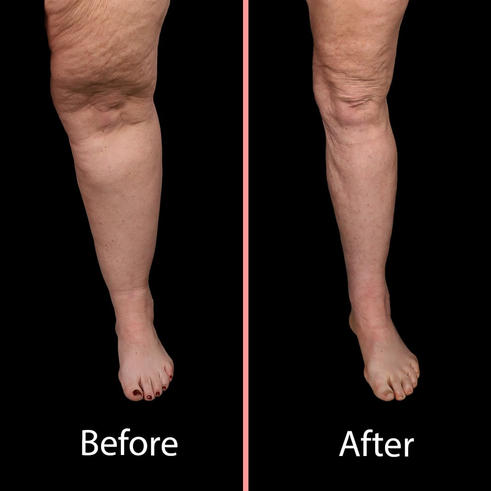 Lipedema before and after advanced lipedema treatment surgery with the roxbury institute Lipedema before and after advanced lipedema treatment surgery with the roxbury institute